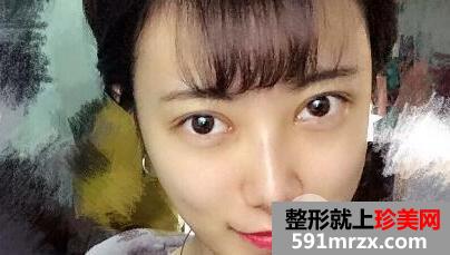 割双眼皮开眼角价格介绍和真人案例分享
