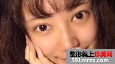 割双眼皮开眼角价格介绍和真人案例分享
