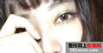 割双眼皮开眼角价格介绍和真人案例分享