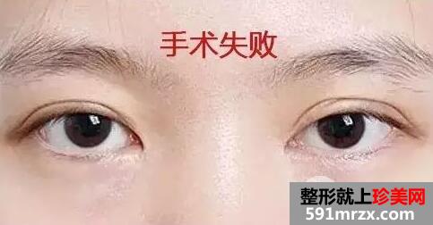 郑大一附院整形双眼皮价格表
