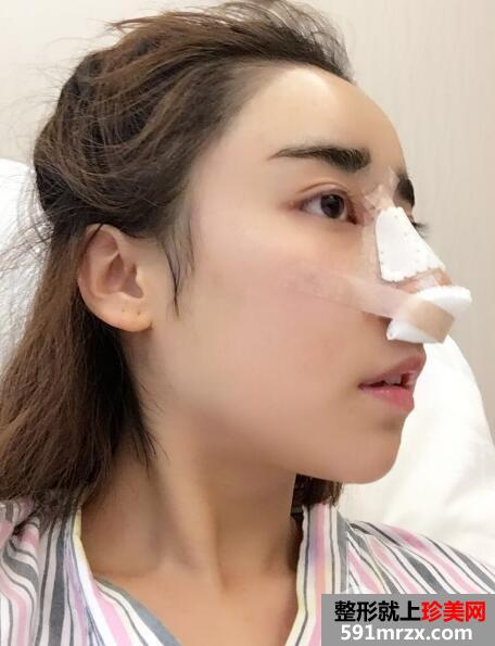 驼峰鼻矫正价钱和图片案例