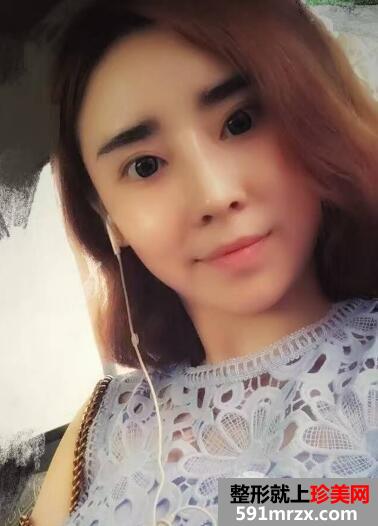 驼峰鼻矫正价钱和图片案例