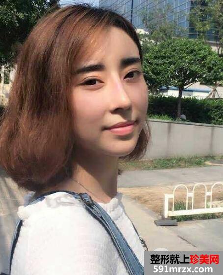 驼峰鼻矫正价钱和图片案例