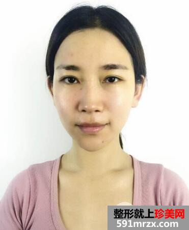 北京禾美嘉自体脂肪面部填充案例