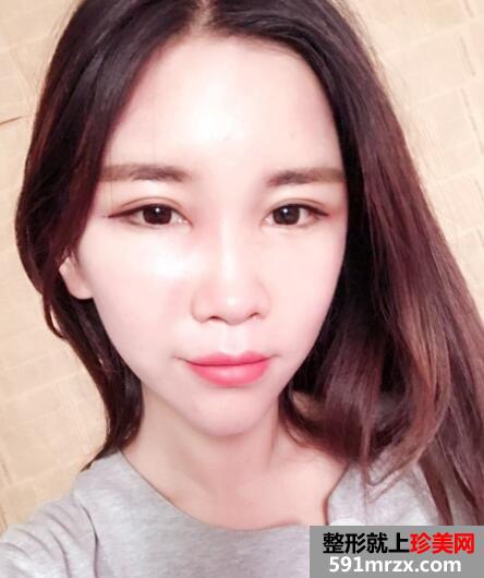 北京禾美嘉自体脂肪面部填充案例