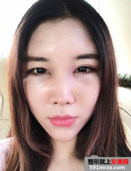 北京禾美嘉自体脂肪面部填充案例
