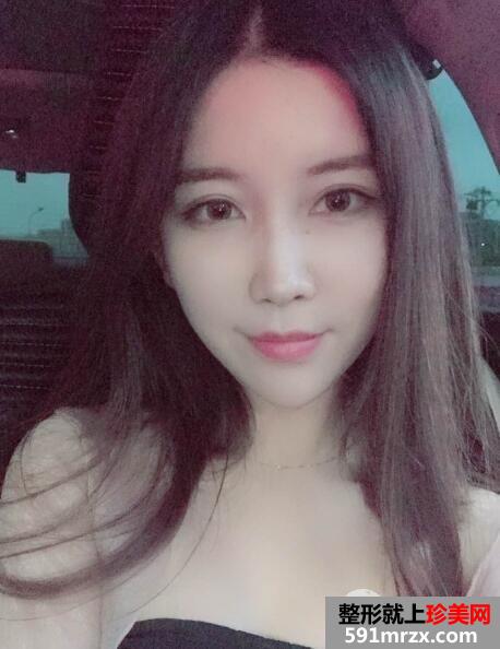 北京禾美嘉自体脂肪面部填充案例