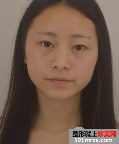 广州南珠整形医院双眼皮案例