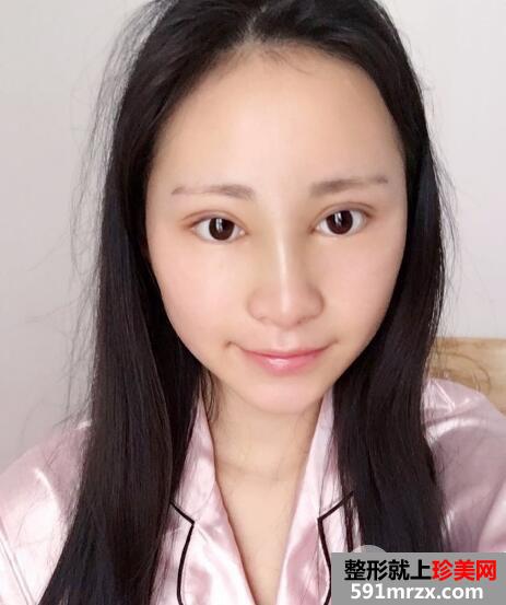 广州南珠整形医院双眼皮案例