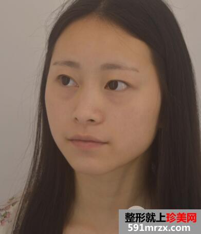 广州南珠整形医院双眼皮案例
