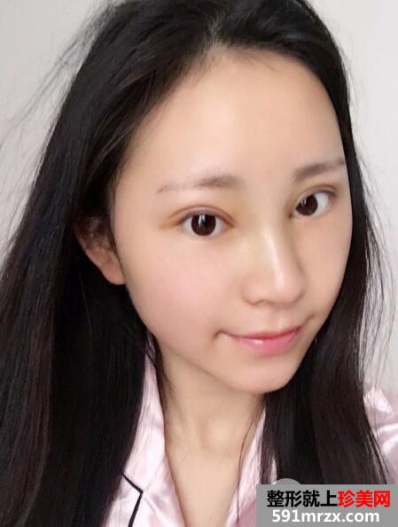 广州南珠整形医院双眼皮案例