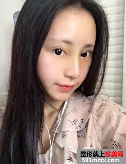 广州南珠整形医院双眼皮案例