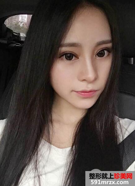 广州南珠整形医院双眼皮案例