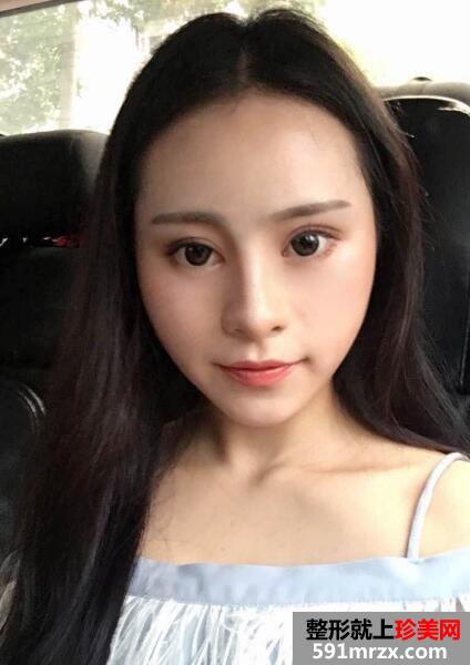 广州南珠整形医院双眼皮案例