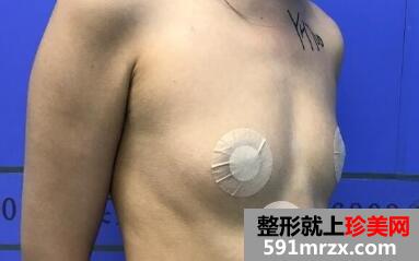 北京东方和谐隆胸图片案例