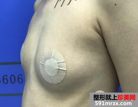 北京东方和谐隆胸图片案例