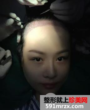 成都恒博医院植发价格和案例