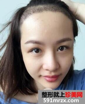 成都恒博医院植发价格和案例