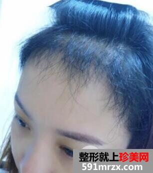 成都恒博医院植发价格和案例