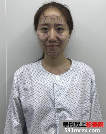 北京东方和谐自体脂肪面部填充价格适宜效果好案例