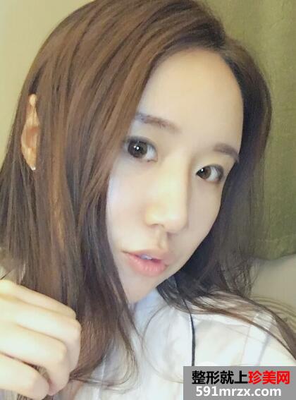 北京东方和谐自体脂肪面部填充价格适宜效果好案例