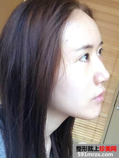 北京东方和谐自体脂肪面部填充价格适宜效果好案例