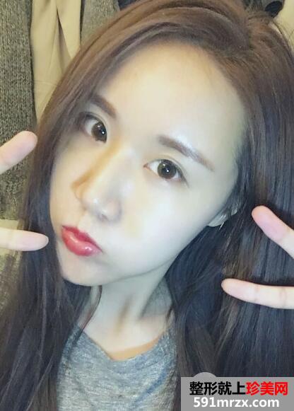 北京东方和谐自体脂肪面部填充价格适宜效果好案例
