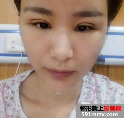 武汉美亚整形医院割双眼皮价格案例