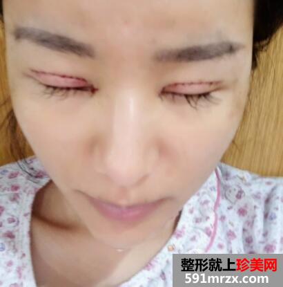武汉美亚整形医院割双眼皮价格案例