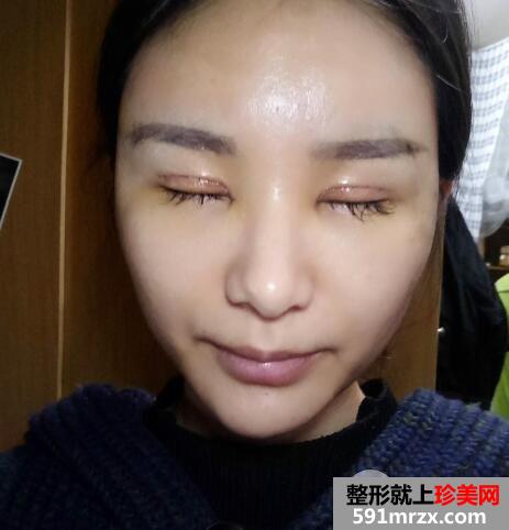 武汉美亚整形医院割双眼皮价格案例