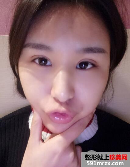 武汉美亚整形医院割双眼皮价格案例