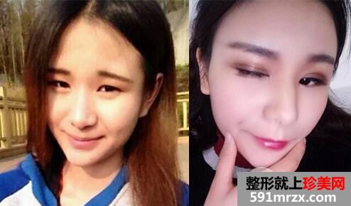 武汉美亚整形医院割双眼皮价格案例