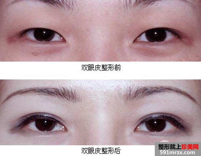 上海华美医疗美容医院靠谱吗？双眼皮微整形价格表