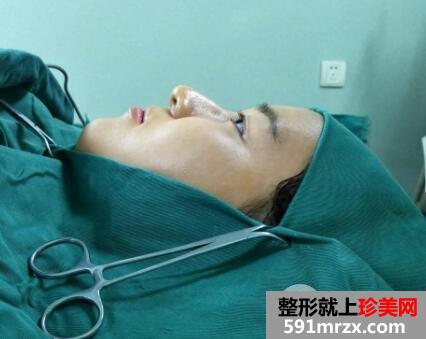 长沙爱思特张娇娇割双眼皮手术案例