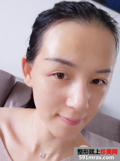 上海九院自体脂肪面部填充微整形真人案例