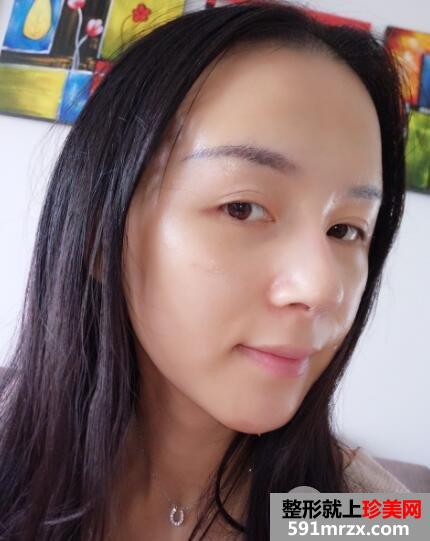 上海九院自体脂肪面部填充微整形真人案例