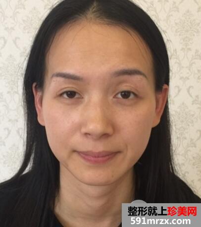 上海九院自体脂肪面部填充微整形真人案例