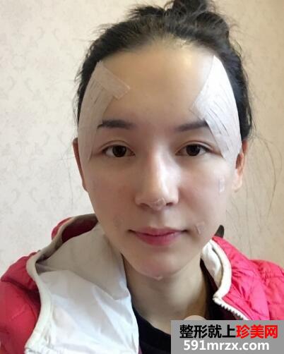 上海九院自体脂肪面部填充微整形真人案例