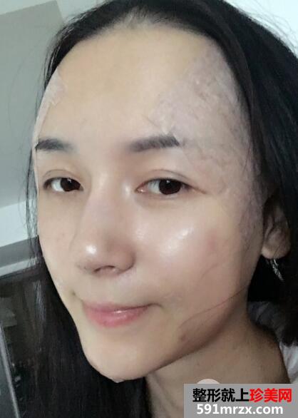 上海九院自体脂肪面部填充微整形真人案例