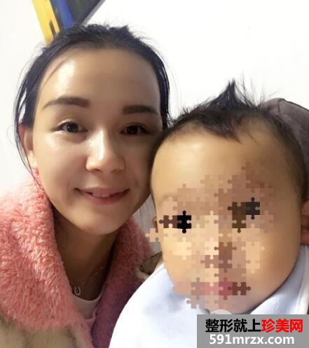 上海九院自体脂肪面部填充微整形真人案例
