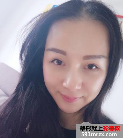 上海九院自体脂肪面部填充微整形真人案例