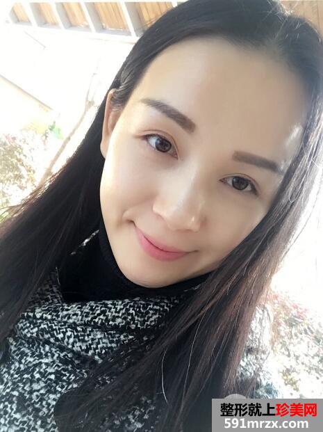 上海九院自体脂肪面部填充微整形真人案例