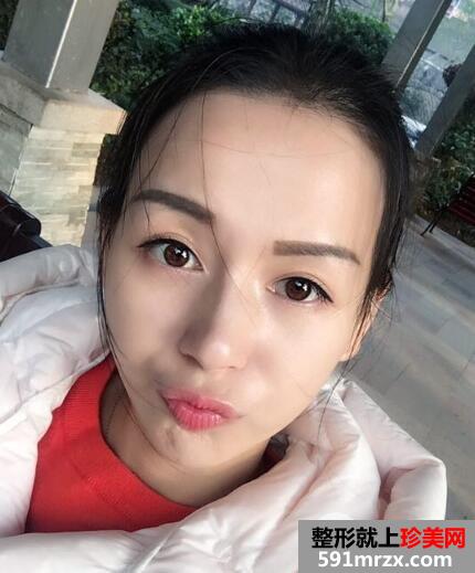 上海九院自体脂肪面部填充微整形真人案例
