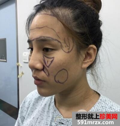 在北京禾美嘉整形脸部脂肪填充价格和4天图片案例