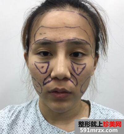 在北京禾美嘉整形脸部脂肪填充价格和4天图片案例