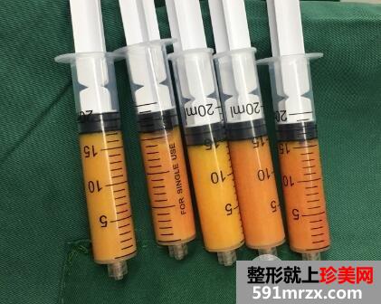 在北京禾美嘉整形脸部脂肪填充价格和4天图片案例