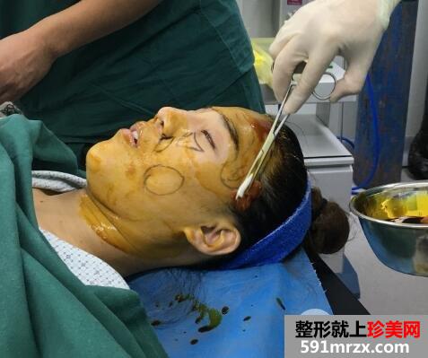 在北京禾美嘉整形脸部脂肪填充价格和4天图片案例