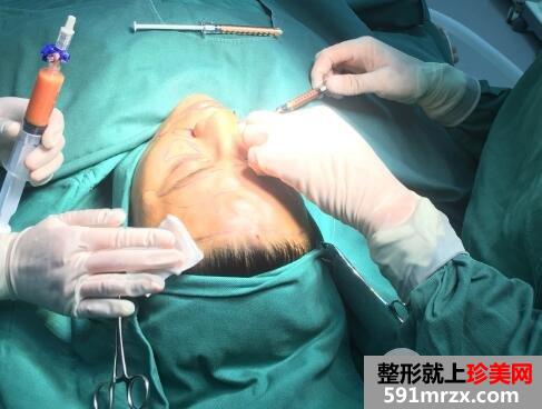 在北京禾美嘉整形脸部脂肪填充价格和4天图片案例