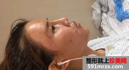在北京禾美嘉整形脸部脂肪填充价格和4天图片案例
