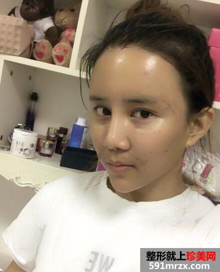 在北京禾美嘉整形脸部脂肪填充价格和4天图片案例